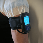 Post-shoulder decompression surgery image showing small adhesive plasters on the shoulder’s incision points. The arm is equipped with Arm Cuffs V4.0 and connected to a BFR Unit, specifically prepared for rehabilitation exercises. This setup highlights the use of Blood Flow Restriction (BFR) training equipment in post-surgery recovery to support muscle strength and healing