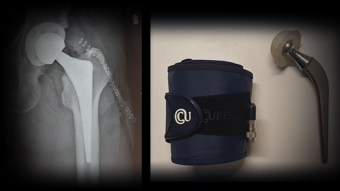Total Hip Replacement (THR) Rehab with Blood Flow Restriction – Part 3/?